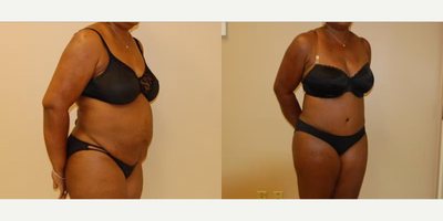 Case 1230 - Woman treated with Tummy Tuck