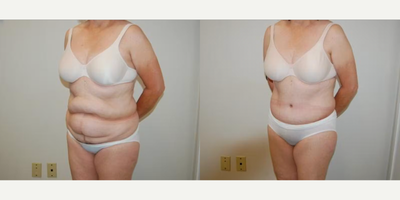 Case 1231 - Woman treated with Tummy Tuck