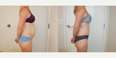 Case 1232 - Woman treated with Tummy Tuck