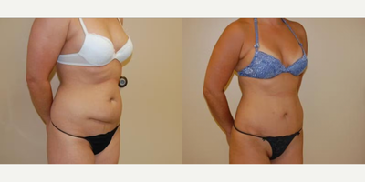 Case 1233 - Woman treated with Tummy Tuck