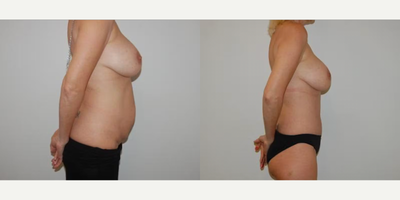 Case 1234 - Woman treated with Tummy Tuck