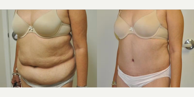 Case 1235 - Woman treated with Tummy Tuck