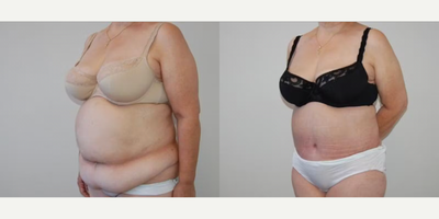 Case 1236 - Woman treated with Tummy Tuck