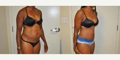 Case 1237 - Woman treated with Tummy Tuck