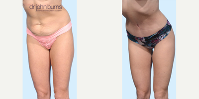 Case 1239 - Woman treated with Tummy Tuck