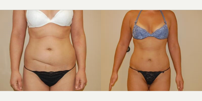 Case 124 - Woman treated with Tummy Tuck