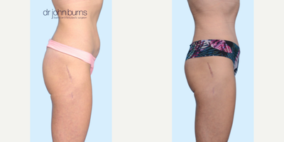 Case 1240 - Woman treated with Tummy Tuck