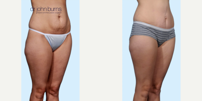 Case 1241 - Woman treated with Tummy Tuck