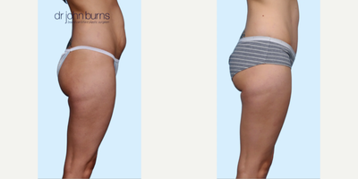 Case 1242 - Woman treated with Tummy Tuck