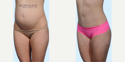 Case 1243 - Woman treated with Tummy Tuck