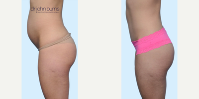 Case 1244 - Woman treated with Tummy Tuck