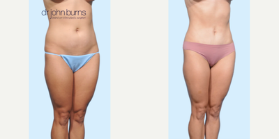 Case 1245 - Woman treated with Tummy Tuck