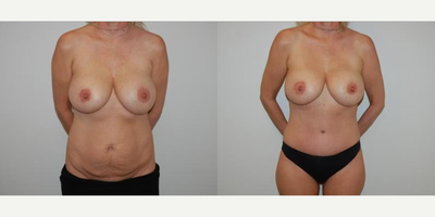 Case 125 - Woman treated with Tummy Tuck