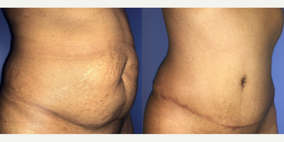 Case 1256 - Woman treated with Tummy Tuck