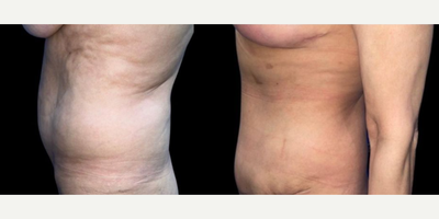 Case 1257 - Woman treated with Tummy Tuck