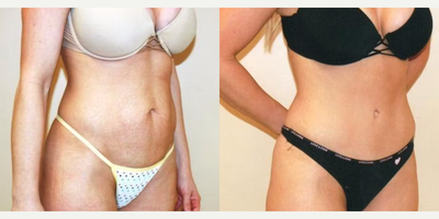 Case 1258 - Woman treated with Tummy Tuck