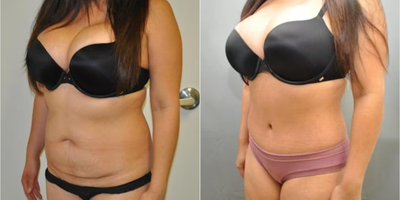 Case 1259 - Woman treated with Tummy Tuck