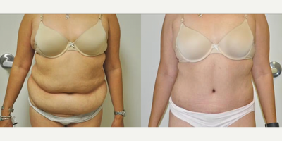 Case 126 - Woman treated with Tummy Tuck