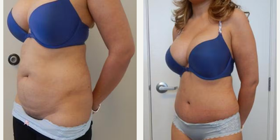 Case 1260 - Woman treated with Tummy Tuck