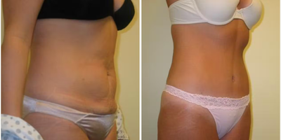 Case 1261 - Woman treated with Tummy Tuck