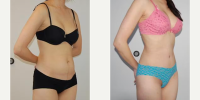 Case 1262 - Woman treated with Tummy Tuck