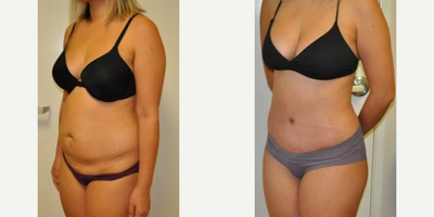 Case 1263 - Woman treated with Tummy Tuck