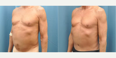 Case 1264 - 65-74 year old man treated with Tummy Tuck