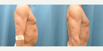 Case 1265 - 65-74 year old man treated with Tummy Tuck