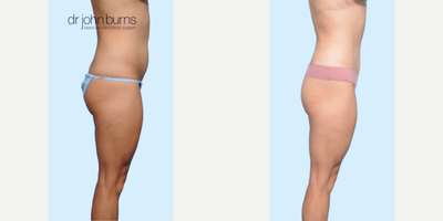 Case 1266 - Woman treated with Tummy Tuck