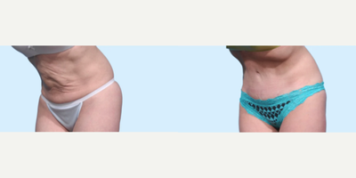 Case 1267 - Woman treated with Tummy Tuck