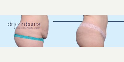 Case 1268 - Woman treated with Tummy Tuck