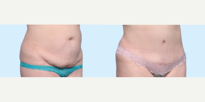 Case 1269 - Woman treated with Tummy Tuck