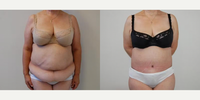 Case 127 - Woman treated with Tummy Tuck