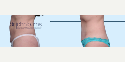 Case 1270 - Woman treated with Tummy Tuck