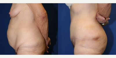 Case 1272 - Woman treated with Tummy Tuck