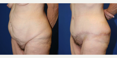 Case 1273 - Woman treated with Tummy Tuck