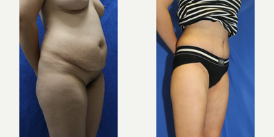 Case 1274 - Woman treated with Tummy Tuck