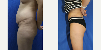 Case 1275 - Woman treated with Tummy Tuck