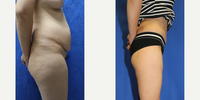 Case 1276 - Woman treated with Tummy Tuck