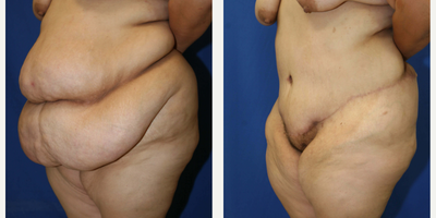 Case 1277 - Woman treated with Tummy Tuck