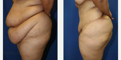 Case 1278 - Woman treated with Tummy Tuck