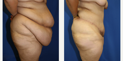 Case 1279 - Woman treated with Tummy Tuck