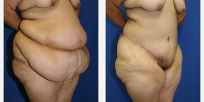 Case 1280 - Woman treated with Tummy Tuck