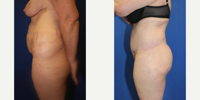 Case 1281 - Woman treated with Tummy Tuck