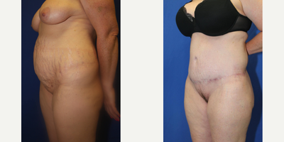 Case 1282 - Woman treated with Tummy Tuck