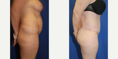 Case 1283 - Woman treated with Tummy Tuck