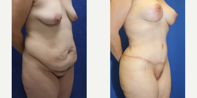 Case 1284 - 25-34 year old woman treated with Tummy Tuck