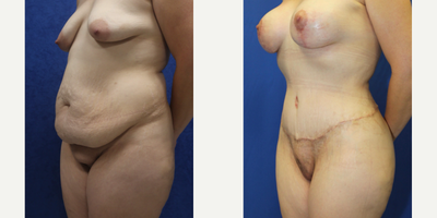 Case 1285 - 25-34 year old woman treated with Tummy Tuck