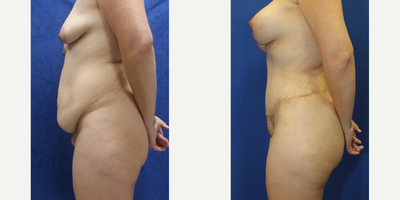 Case 1286 - 25-34 year old woman treated with Tummy Tuck