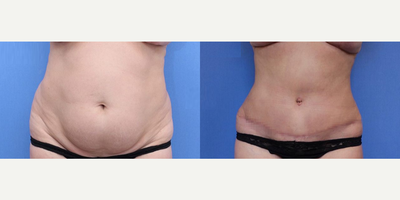 Case 1287 - Woman treated with Tummy Tuck